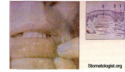 ЭЛЕМЕНТЫ ПОРАЖЕНИЯ СЛИЗИСТОЙ ОБОЛОЧКИ ПОЛОСТИ РТА. ИХ ХАРАКТЕРИСТИКА