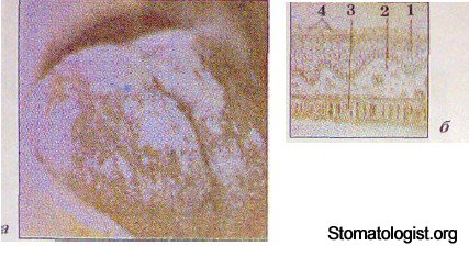 ЭЛЕМЕНТЫ ПОРАЖЕНИЯ СЛИЗИСТОЙ ОБОЛОЧКИ ПОЛОСТИ РТА. ИХ ХАРАКТЕРИСТИКА