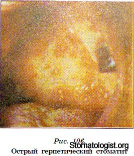 ХАРАКТЕРИСТИКА ОСТРОГО ГЕРПЕТИЧЕСКОГО СТОМАТИТА У ДЕТЕЙ