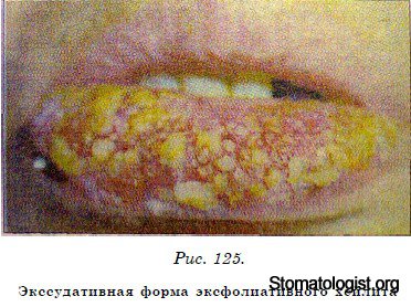 ИЗМЕНЕНИЯ ПОЛОСТИ РТА ПРИ ГЕММОРАГИЧЕСИХ ДИАТЕЗАХ. БОЛЕЗНЬ РСЛЕРА-РЕНДЮ