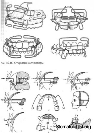 Глубокий прикус