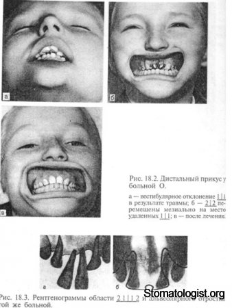 Повреждение временных и постоянных зубов