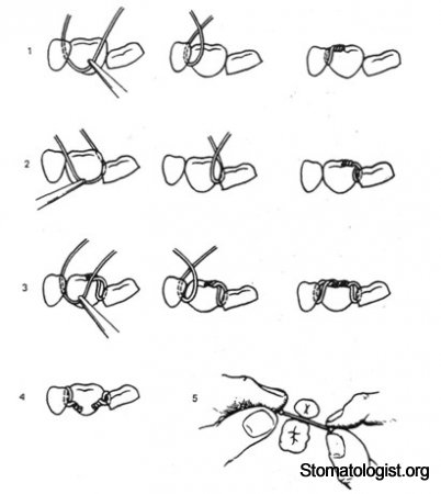 Изготовление индивидуальных колец на опорные моляры, припаивание или приваривание к ним замков-трубок или подбор стандартных колец. 