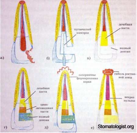 ОСОБЕННОСТИ ЛЕЧЕНИЯ ПУЛЬПИТА ЗУБОВ С НЕСФОРМИРОВАННЫМИ ИЛИ РЕЗОРБИРУЮЩИМИСЯ КОРНЯМИ