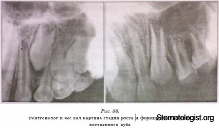 ПЕРИОДОНТИТЫ. СТРОЕНИЕ ПЕРИОДОНТА