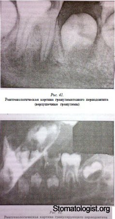 Диагностика острых периодонтитов у детей