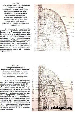 Генерализованый пародонтит