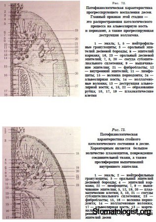 Генерализованый пародонтит