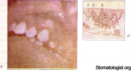 ЭЛЕМЕНТЫ ПОРАЖЕНИЯ СЛИЗИСТОЙ ОБОЛОЧКИ ПОЛОСТИ РТА. ИХ ХАРАКТЕРИСТИКА