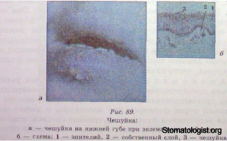 ЭЛЕМЕНТЫ ПОРАЖЕНИЯ СЛИЗИСТОЙ ОБОЛОЧКИ ПОЛОСТИ РТА. ИХ ХАРАКТЕРИСТИКА