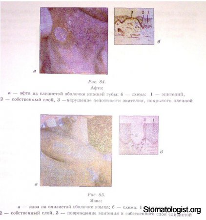 ЭЛЕМЕНТЫ ПОРАЖЕНИЯ СЛИЗИСТОЙ ОБОЛОЧКИ ПОЛОСТИ РТА. ИХ ХАРАКТЕРИСТИКА