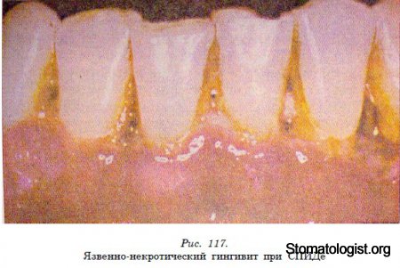 ПРОЯВЛЕНИЯ СПИДА НА СЛИЗИСТОЙ ОБОЛОЧКЕ ПОЛОСТИ РТА