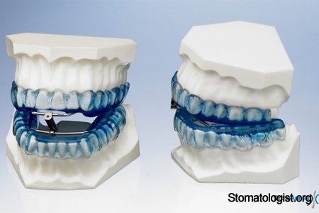 Интраоральные шины OrthoApnea для лечения храпа