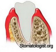 Из-за чего опухают десна?