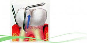 Кюретаж и хирургические операции на деснах