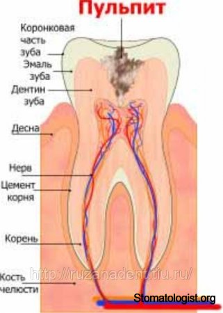 Симптомы пульпита