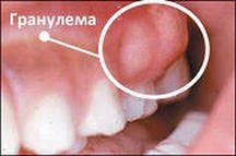 Гранулема зуба. Лечение гранулемы.