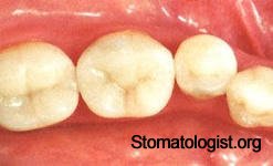 Отличия зубной вкладки от пломбы