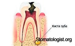 Как лечить кисту зуба?