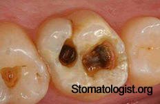 Кариес молочных и постоянных зубов (кариозные полости)