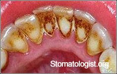 Зубной камень
