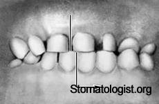Лечение перекрестного прикуса